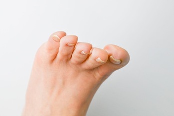 深爪に注意していても巻き爪の傾向が現れやすい人の根本原因は歩き方?