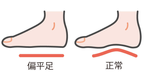 その足痛、「偏平足」かも？　症状と対策まとめ