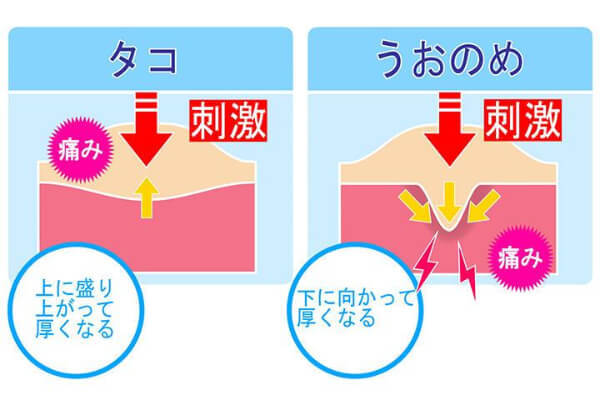 タコ・魚の目を防ぐには？　違いやケア方法について知ろう