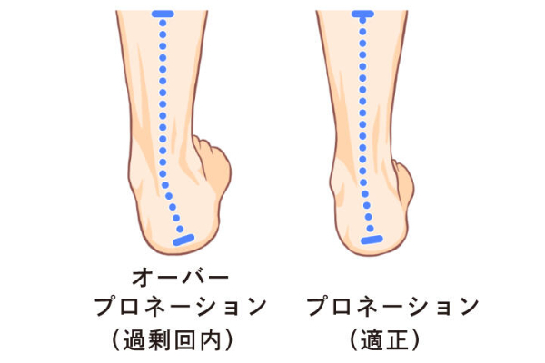 過剰回内（オーバープロネーション）とは何か？　足の不調を引き起こすしくみと対策