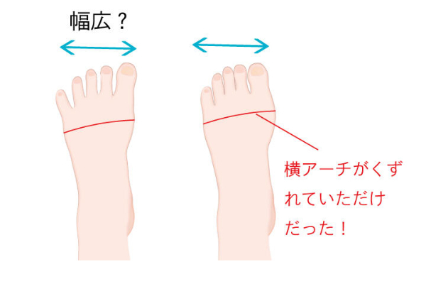 その幅広足、「横アーチの崩れ」かもしれません。　違いや原因について