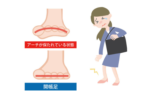 足幅が広がる 「開帳足」の原因とは？　偏平足・幅広足との違いと正しい対策