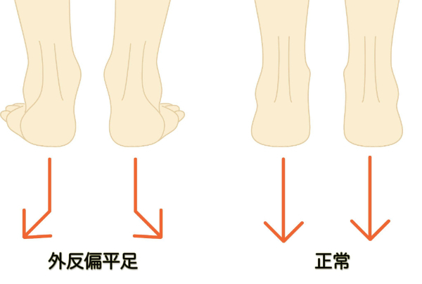 外反偏平足