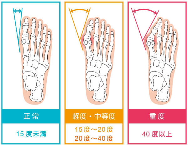 外反母趾